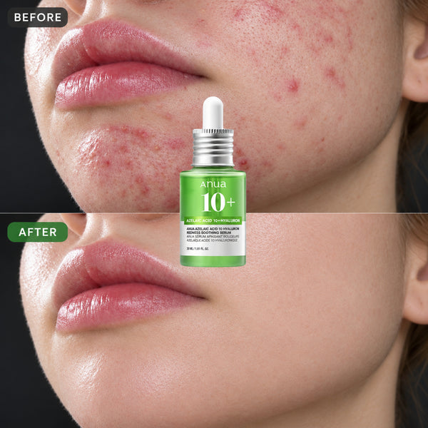 Anua Azelaic Acid 10 Hyaluron Redness Soothing Serum 30ml